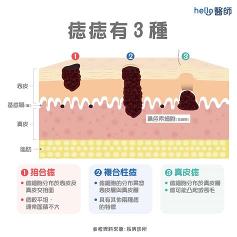 痣的形成原因